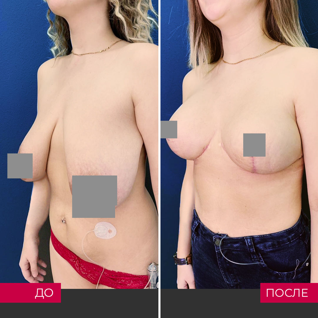 как восстановить одну грудь после кормления фото 73